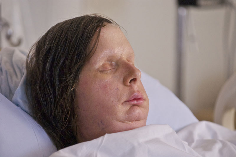 In this undated photo provided by Brigham and Women's Hospital, Charla Nash is seen after her May, 2011, face transplant at the hospital. The Connecticut woman was mauled by a chimpanzee in 2009.