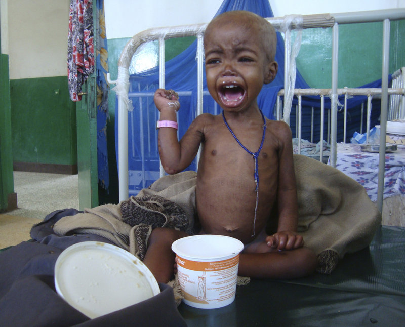 A child is treated Tuesday at a hospital in Mogadishu, Somalia. Some 12 million Somalis are facing starvation.