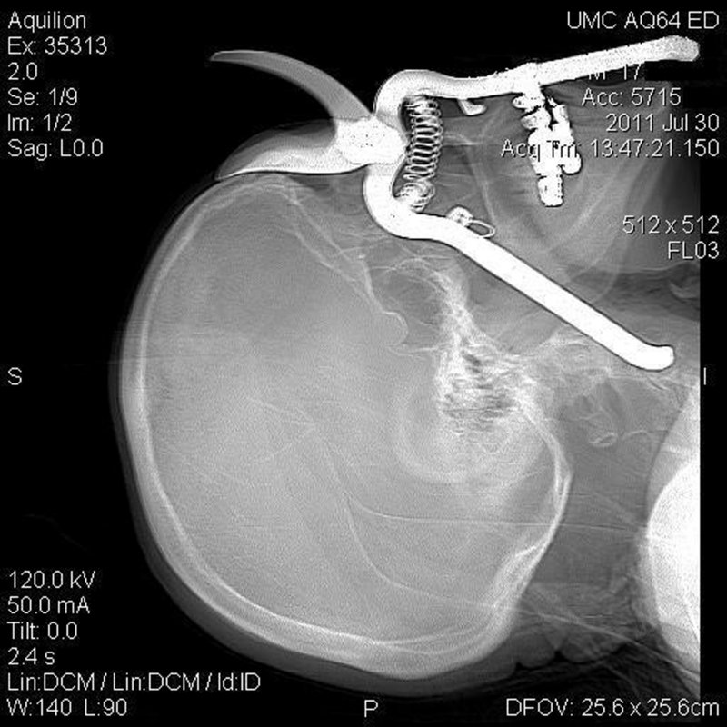 A CT scan shows a pair of pruning shears embedded in an Arizona man’s head.