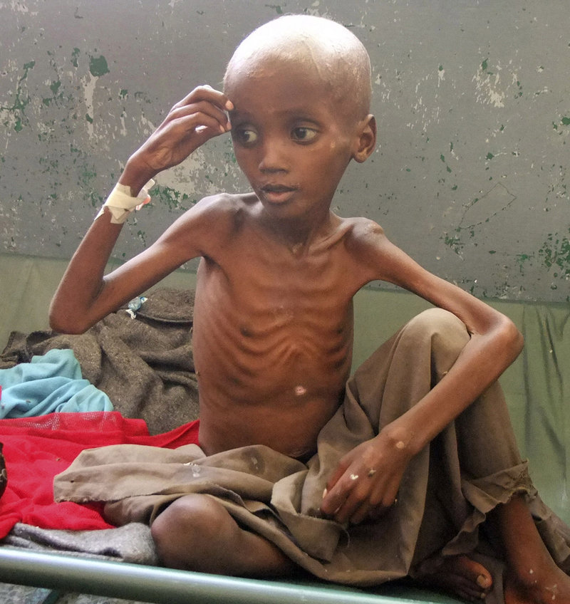 A severely malnourished child from southern Somalia sits in a Mogadishu hospital Monday. Famine continues to spread, leading the U.N. to declare a sixth famine zone on Monday.