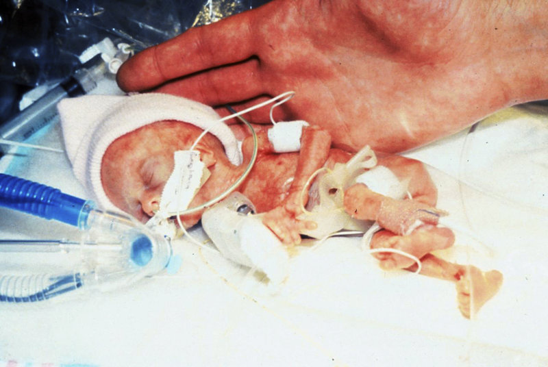 A June 1989 photo provided by Loyola University Medical Center in Maywood, Ill., shows Madeline Mann shortly after her birth, weighing 9.9 ounces. She is now an honors college student studying psychology. The doctor who resuscitated Madeline and a 9.2-ounce baby who is also thriving said that their remarkable health years later shouldn’t raise false hope.