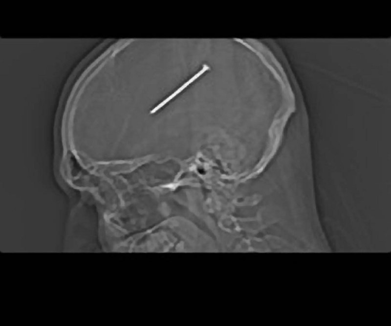 An X-ray shows a nail embedded in Dante Autullo’s brain. It was removed during a two-hour surgery.
