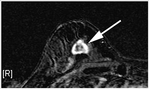 This undated shows a right breast MRI from a 55-year-old woman with extreme breast density. The arrow points to a 2-centimeter lesion later confirmed by biopsy to be invasive breast cancer. Doctors have successfully dropped the first "smart bomb" on breast cancer, using a drug to deliver a toxic payload to tumor cells while leaving healthy ones alone.