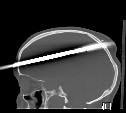 In this undated image provided by University of Miami/Jackson Memorial Hospital shows the spear lodged in Yasser Lopez's skull.