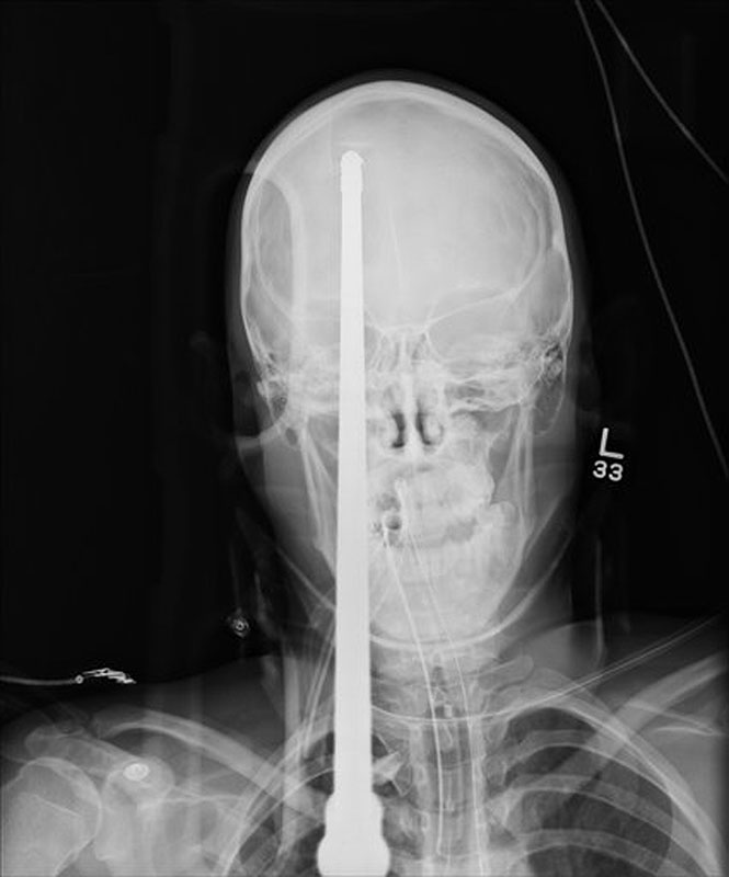 In this undated image provided by University of Miami/Jackson Memorial Hospital, a spear accidentally shot through Yasser Lopez's skull is seen. Lopez, 16, was in serious condition Tuesday, June 19, 2012, at Jackson Memorial Hospitalís Ryder Trauma Center. Hospital officials say one of Lopezís friends was loading a speargun when it accidentally fired. Lopez was taken to the trauma center June 7 with roughly 3 feet of the spear protruding from his forehead. (AP Photo/University of Miami/Jackson Memorial Hospital)