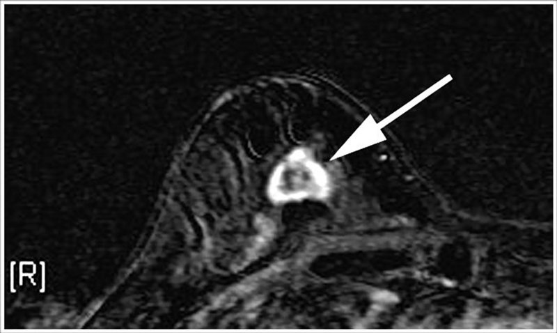 An undated image made available in 2007 shows an MRI of a 55-year-old woman’s breast. The arrow points to a lesion that was later confirmed by biopsy to be cancer. Doctors reported Sunday that they have successfully used a drug to deliver poison to tumor cells while leaving healthy ones alone.