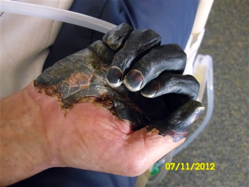 This photo supplied by the Gaylord family taken July 11, 2012, at a hospital in Bend, Ore., shows the blackened hand of Paul Gaylord as he recovers from the plague. Gaylord contracted the disease when he tried to pull a mouse out of the mouth of his cat, Charlie, because it was choking on the rodent. The disease, a version of the medieval scourge that wiped out at least a third of Europe, took away the 59-year-old welder's fingertips, his toes and his ability to make a living. He faces an arduous recovery surrounded by constant reminders of his misery, the infected cat died, and the trailer he's living in has a mouse problem. (AP Photo/The Gaylord Family)