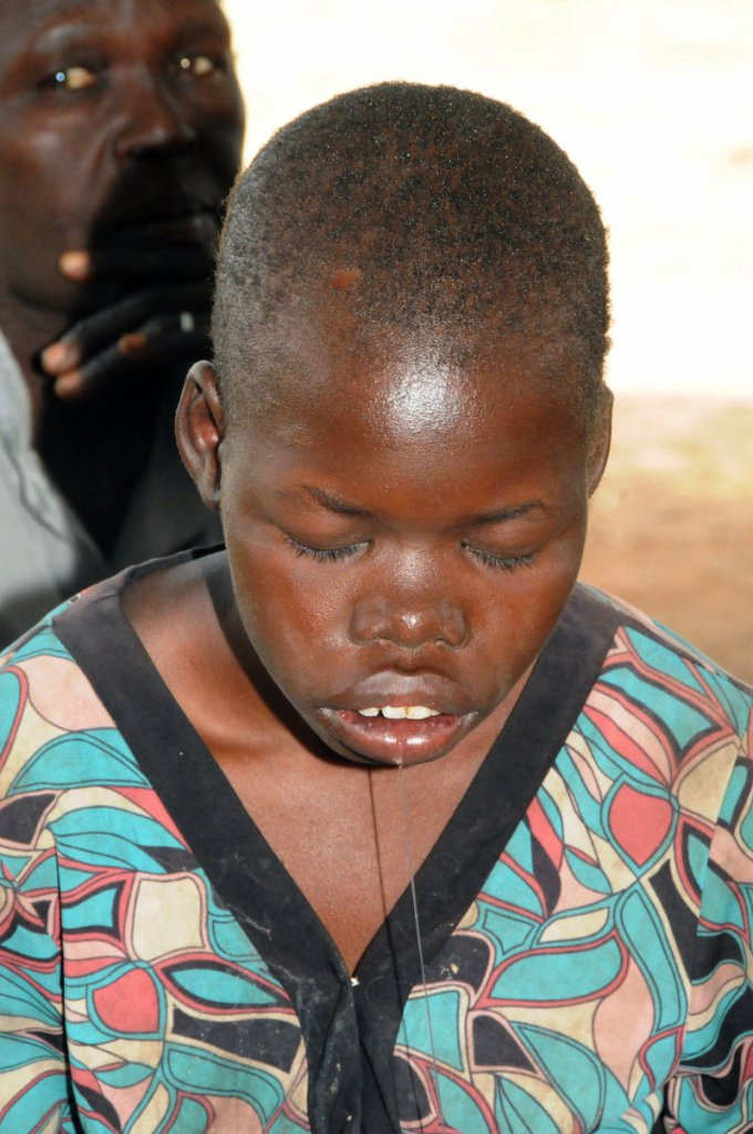 Vicky Apara, a 15-year-old Ugandan girl, suffers from nodding head disease, which stunts growth and destroys cognition. More than 300 young Ugandans have died from the illness that continues to defy explanation.