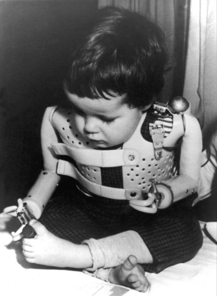 A 1965 file photo shows a 3-year-old girl born without arms to a mother who took thalidomide. Gruenenthal has for the first time apologized to people who were born with congenital birth defects as a result of the drug's use.