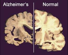 This image shows a cross section of a normal brain, right, and one of a brain damaged by Alzheimer’s disease.