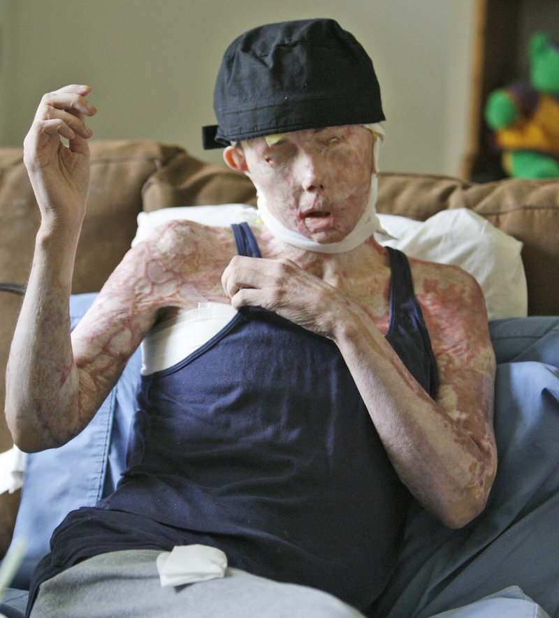 In this Aug. 20, 2008, file photo, Carmen Tarleton is interviewed in her home in Thetford , Vt. The Vermont woman who was disfigured and blinded in a lye attack by her ex-husband has written a book recounting her experiences. (AP Photo/Toby Talbot)