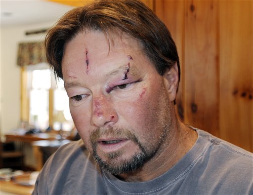Roger Mundell Jr. bears cuts on his face from an attack by a bobcat in his garage in Brookfield, Mass. The cat ran out of the garage and bit Mundell's 15-year-old nephew on the arms and back before it was shot dead.