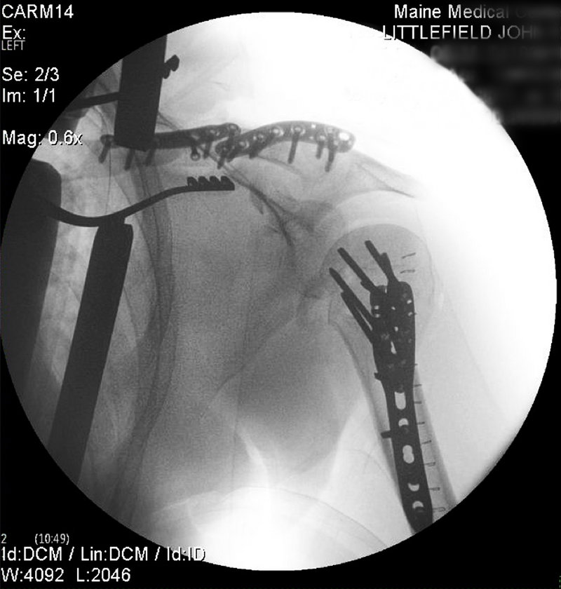 A post-surgey X-ray shows the metal plates and screws implanted in John Littlefield's left shoulder to repair the injuries he suffered when fireworks misfired at Portland's 2012 Independence Day festivities. LIttlefield said doctors treated him for a broken humerus, clavicle, scapula, neck vertebrae, ribs, and a collapsed lung. Littlefield was contracted by Atlas Fireworks to work as part of the fireworks crew on the barge holding the fireworks that night.