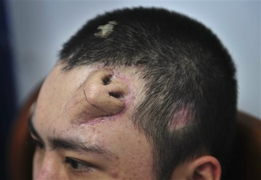 In this Tuesday Sept. 24, 2013 photo, a 22-year-old patient, with a surgical made extra nose out of his rib cartilage and implanted under the skin of his forehead, rests at Fujian Medical University Union Hospital, in Fuzhou city, in southeast China's Fujian province. A surgeon in China said he has constructed the extra nose to prepare for a transplant in probably the first operation of its kind. Surgeon Guo Zhihui at the hospital spent nine months cultivating the graft for the man whose nose was damaged.