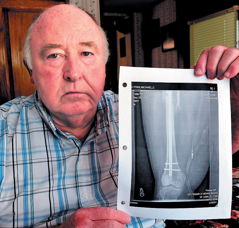 Mike Lyons holds a copy of an X-ray of his femur that was repaired after it was seriously injured in 2008.