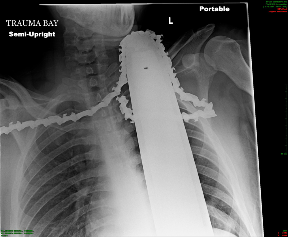 An X-ray shows a chain saw blade embedded in the neck of James Valentine.