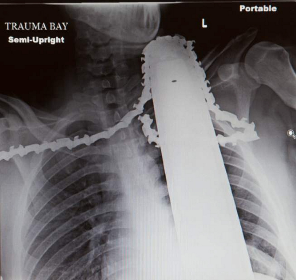 This X-ray of James Valentine shows a chain saw blade lodged 2 inches into his neck. Valentine, of Pittsburgh, Pa., received about 30 stitches, doctors at Allegheny General Hospital told the Tribune-Review newspaper.