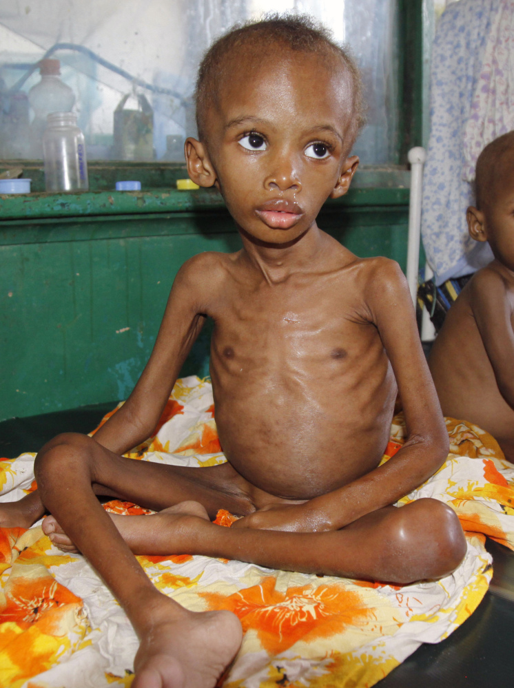 Somalian children such as this malnourished boy are said to be most at risk.