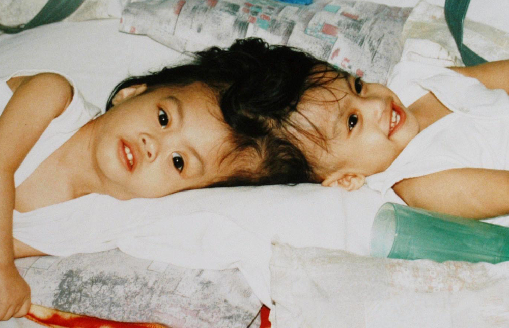 Carl, left, and Clarence Aguirre are shown at 17 months old in 2003. Although doctors in the Philippines said only one could be saved, doctors at Montefiore Medical Center in the Bronx separated and saved both in 2004.