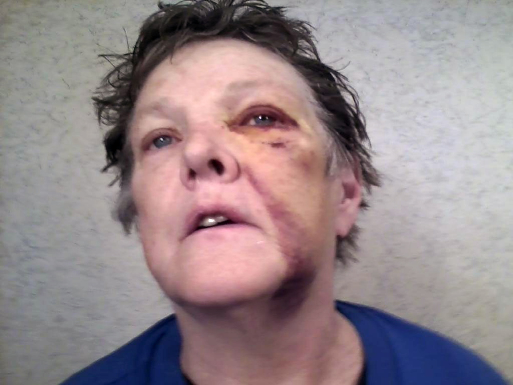 Nancy Austin after the Saturday attack at Riverview Psychiatric Center, in which a 23-year-old patient is accused of hitting her with a chair.