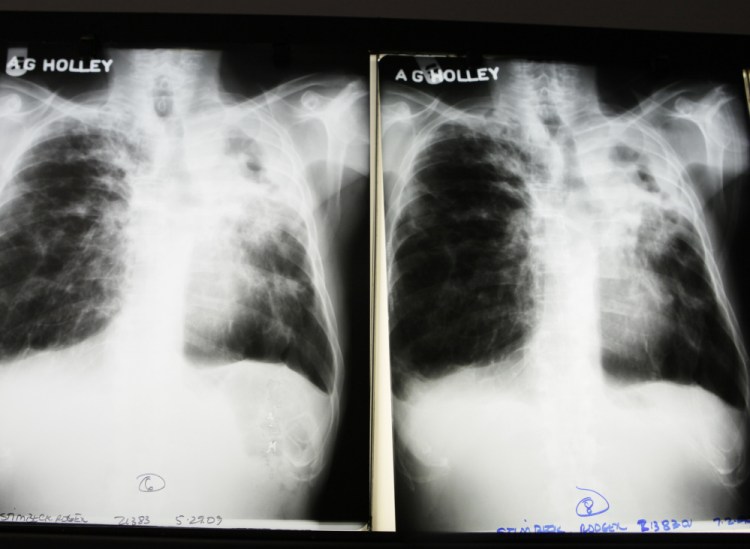 Tuberculosis is a serious airborne bacterial disease that primarily attacks the lungs, as shown in this X-ray photo. The active form is contagious, while people latently infected are not contagious.