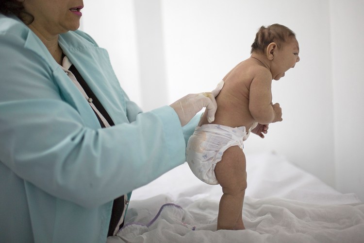 Lara, who is less then 3-months-old and was born with microcephaly, is examined by a neurologist at the Pedro I hospital in Campina Grande, Paraiba state, Brazil. The Associated Press