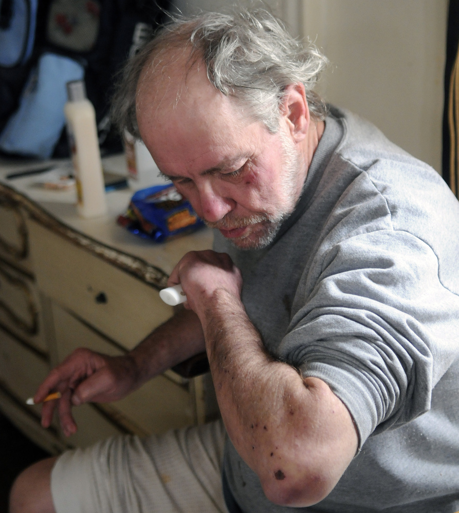 Al Sugden said on Tuesday that bedbugs caused welts on his arm in his unit at 382 Water St. in Augusta.