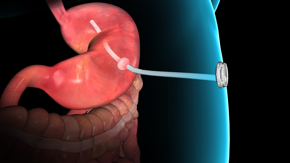 This rendering provided by Aspire Bariatrics Inc. demonstrates the use of the AspireAssist weight loss device. A thin tube implanted in the stomach connects to an outside port on the skin of the belly, which itself connects to an external device that conducts pre-digested caloric material into a waste receptacle.