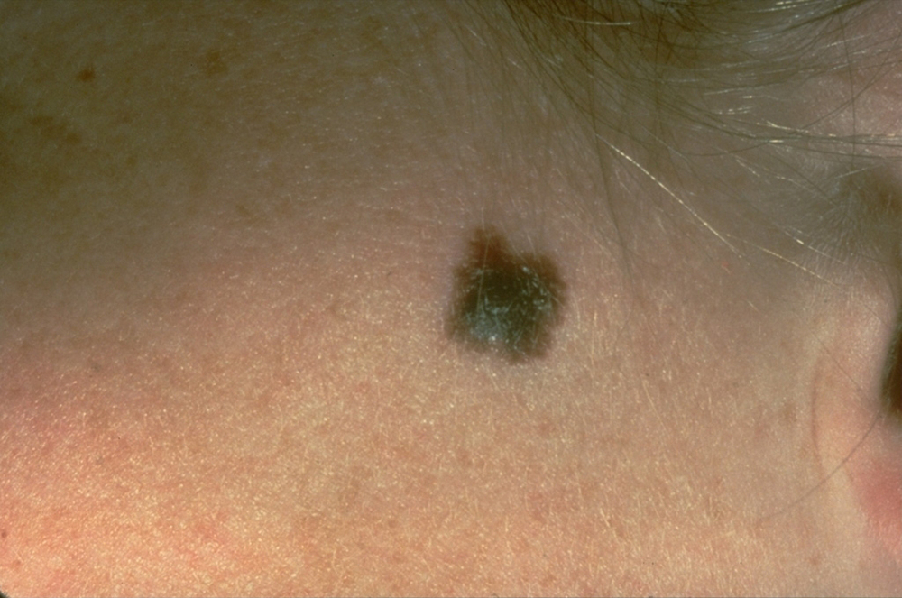A typical presentation of a suspicious mole that eventually was diagnosed as melanoma. A study released Wednesday indicates that Maine was the only state in New England where melanoma incidence and death rates rose between 2003 and 2013.