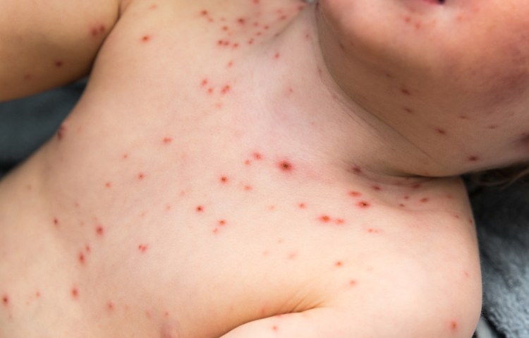 Chicken pox is both potentially dangerous – in severe cases, children can wind up with swelling of the brain – and entirely preventable.