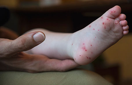 Symptoms of hand, foot, and mouth disease often include fever, sore throat
and rashes of flat red spots that may blister on the palms of the hands, soles of the feet.