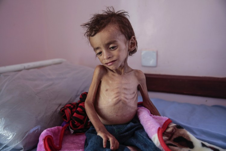 A malnourished boy sits on a hospital bed last month at the Aslam Health Center in Hajjah, Yemen. The U.S. has long remained silent on the war.