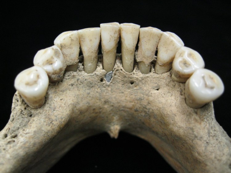 The dental calculus on the lower jaw where a medieval woman entrapped lapis lazuli pigment, seen below the center tooth. The semi-precious stone was highly prized at the time for its vivid color and was ground up and used as a pigment. From this discovery, scientists concluded the woman was an artist involved in creating illuminated manuscripts, a task usually associated with monks.