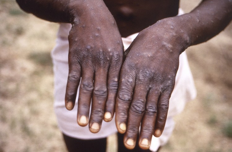 The characteristic rash during the recuperative stage of a monkeypox case on a patient in 1997 in the Democratic Republic of the Congo.

 