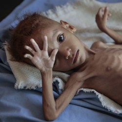 Yemen Starvation